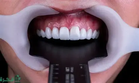 سعر ابتسامة هوليود في السعودية